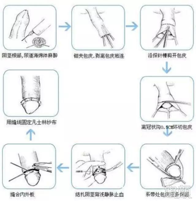 多大手术包皮做可以全麻_多大可以做包皮手术_多大手术包皮做可以延长时间