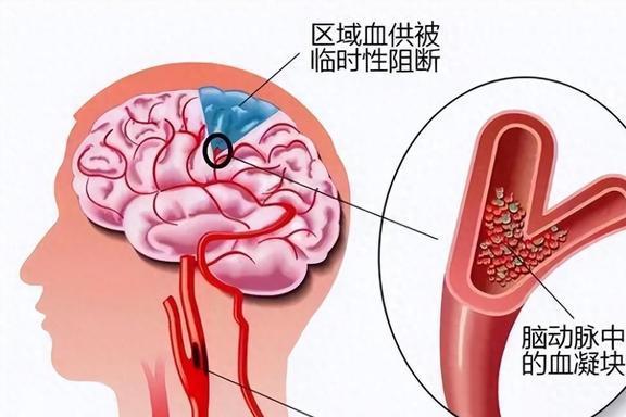 世界卒中日-卒中，不只是疾病！预防从健康生活开始